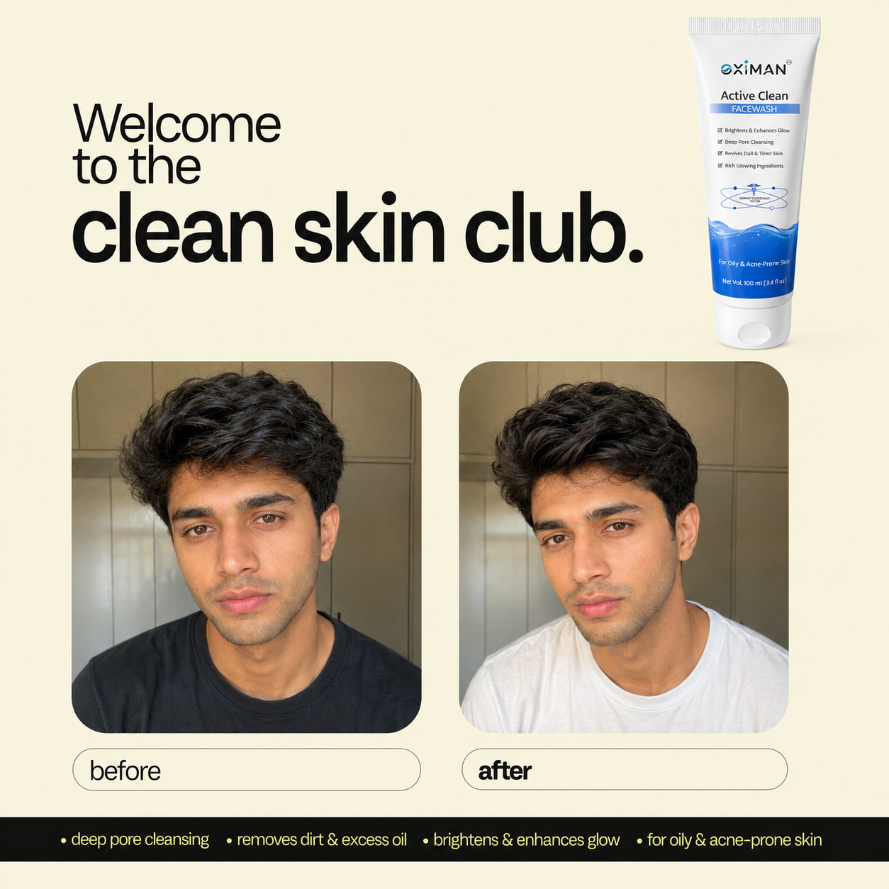 Blackheads